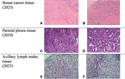 Breast metastasis from lung adenocarcinoma: a case report and review of the literature